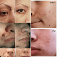 Electric Laser Plasma Pen Mole Removal Dark Spot Remover Skin Wart Tag Tattoo - ElectronicEssence